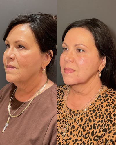 Facial Balancing Before & After Gallery - Patient 678734 - Image 1
