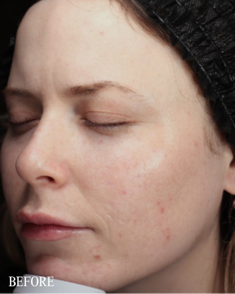 PRX DERM PERFEXION Before & After Gallery - Patient 660114 - Image 1