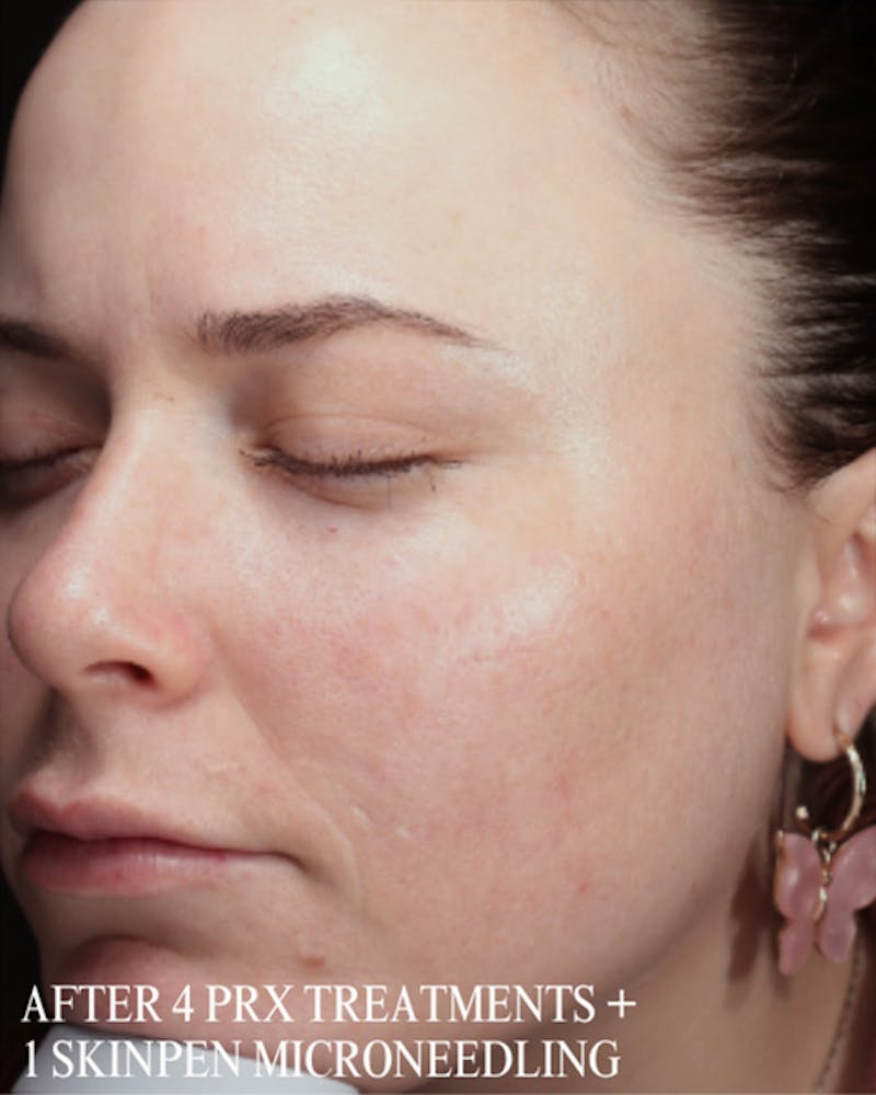 PRX DERM PERFEXION Before & After Gallery - Patient 660114 - Image 2