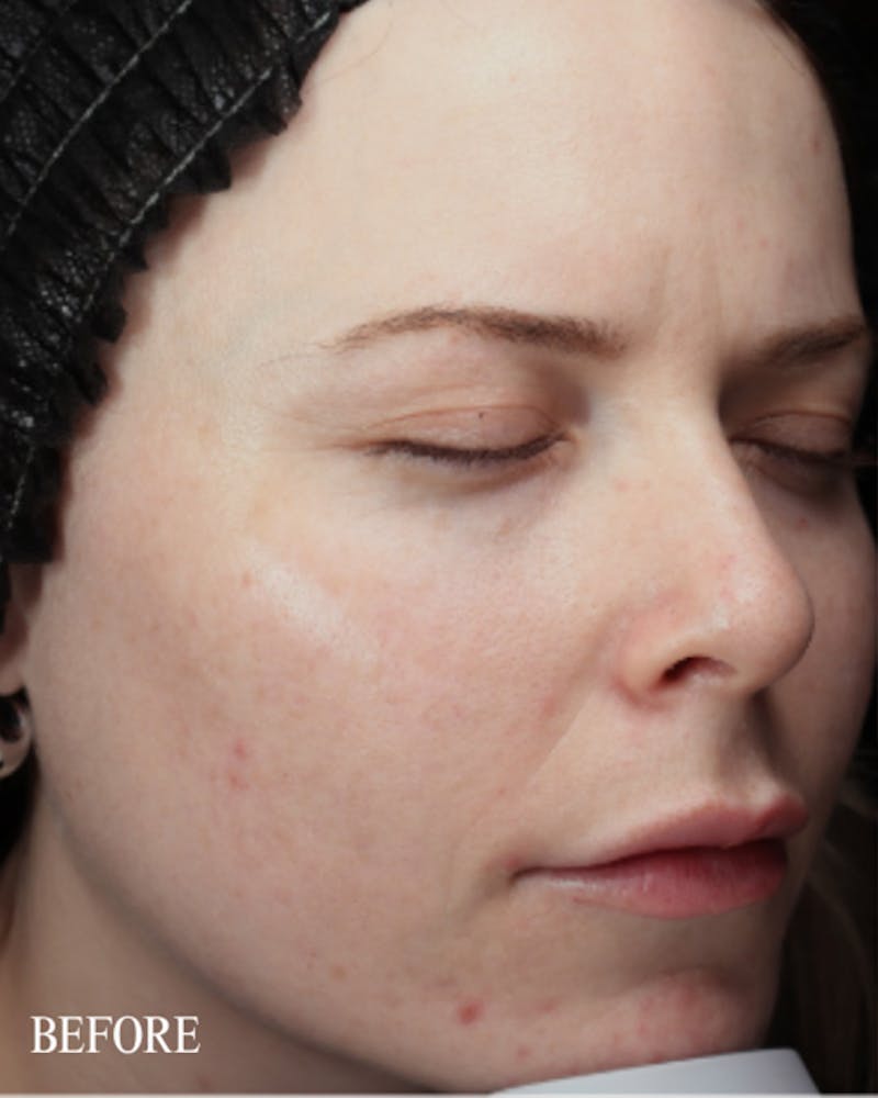 PRX DERM PERFEXION Before & After Gallery - Patient 660114 - Image 3