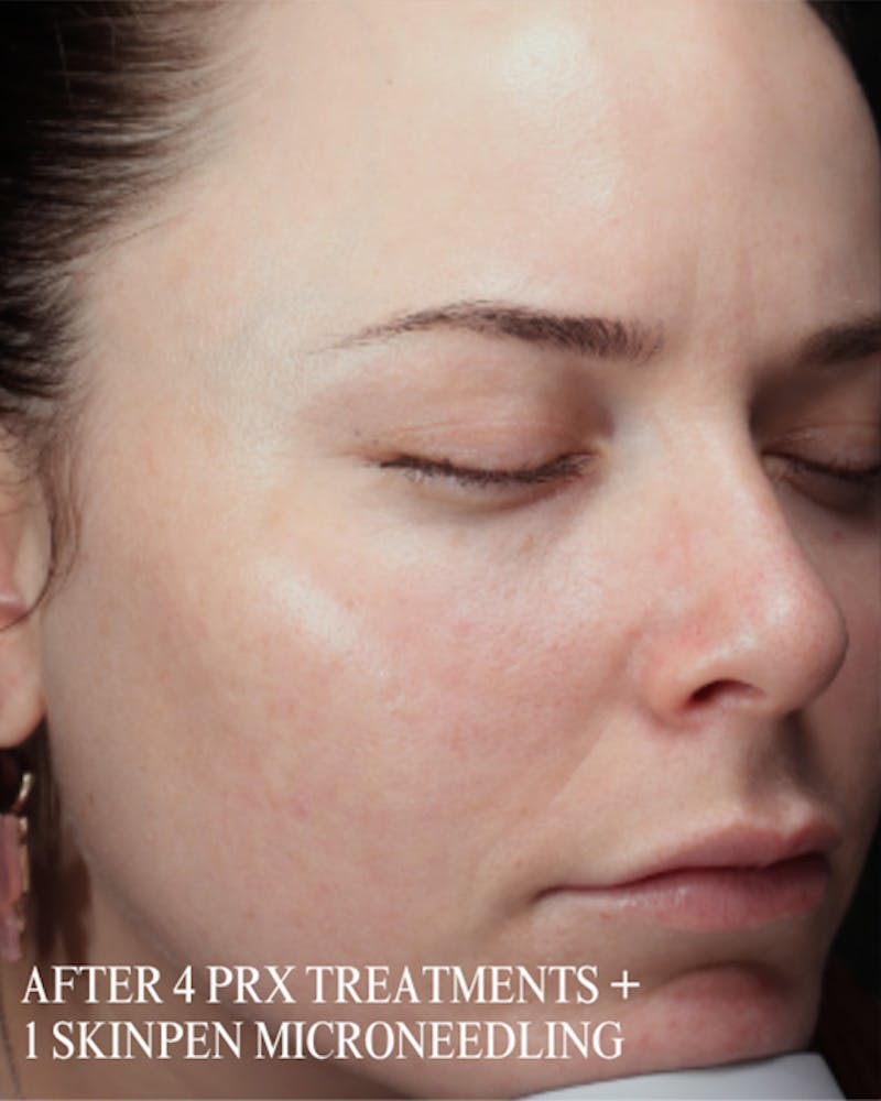 PRX DERM PERFEXION Before & After Gallery - Patient 660114 - Image 4