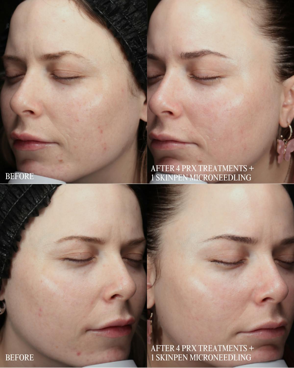 SkinPen Microneedling Before & After Gallery - Patient 255276 - Image 1