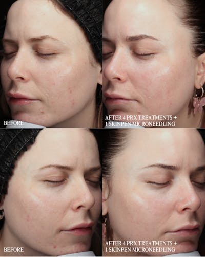 SkinPen Microneedling Before & After Gallery - Patient 255276 - Image 1