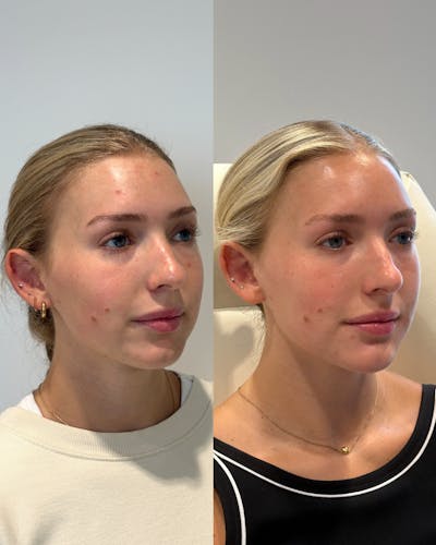 Filler Before & After Gallery - Patient 411227 - Image 1