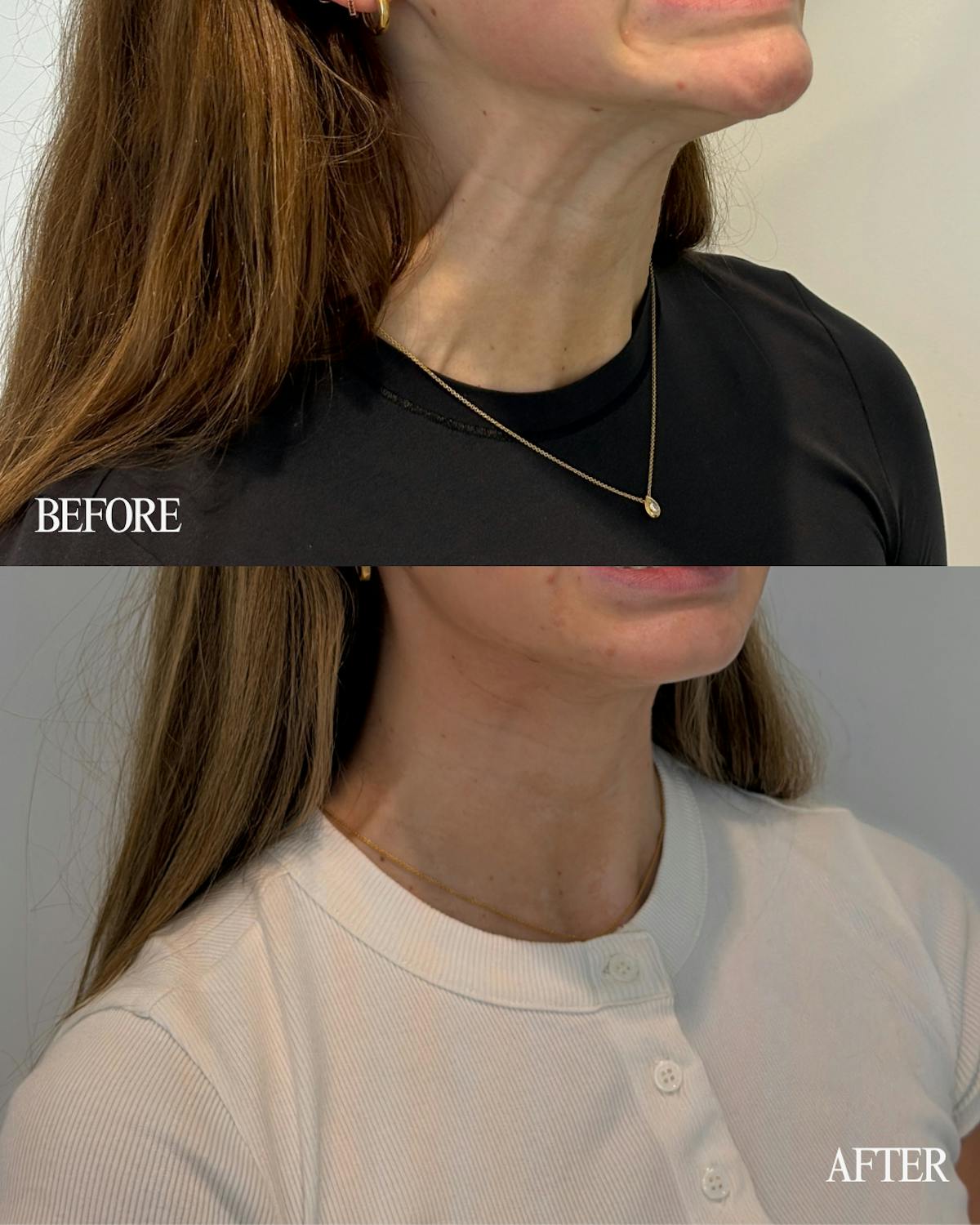 Nefertiti Neck Lift Before & After Gallery - Patient 650487 - Image 1