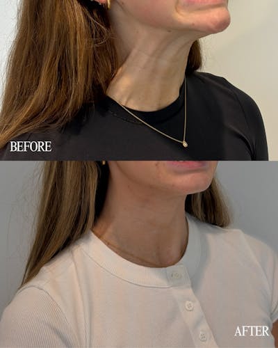 Nefertiti Neck Lift Before & After Gallery - Patient 650487 - Image 1