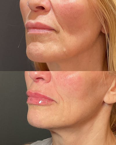 Lip Filler Before & After Gallery - Patient 354573 - Image 1
