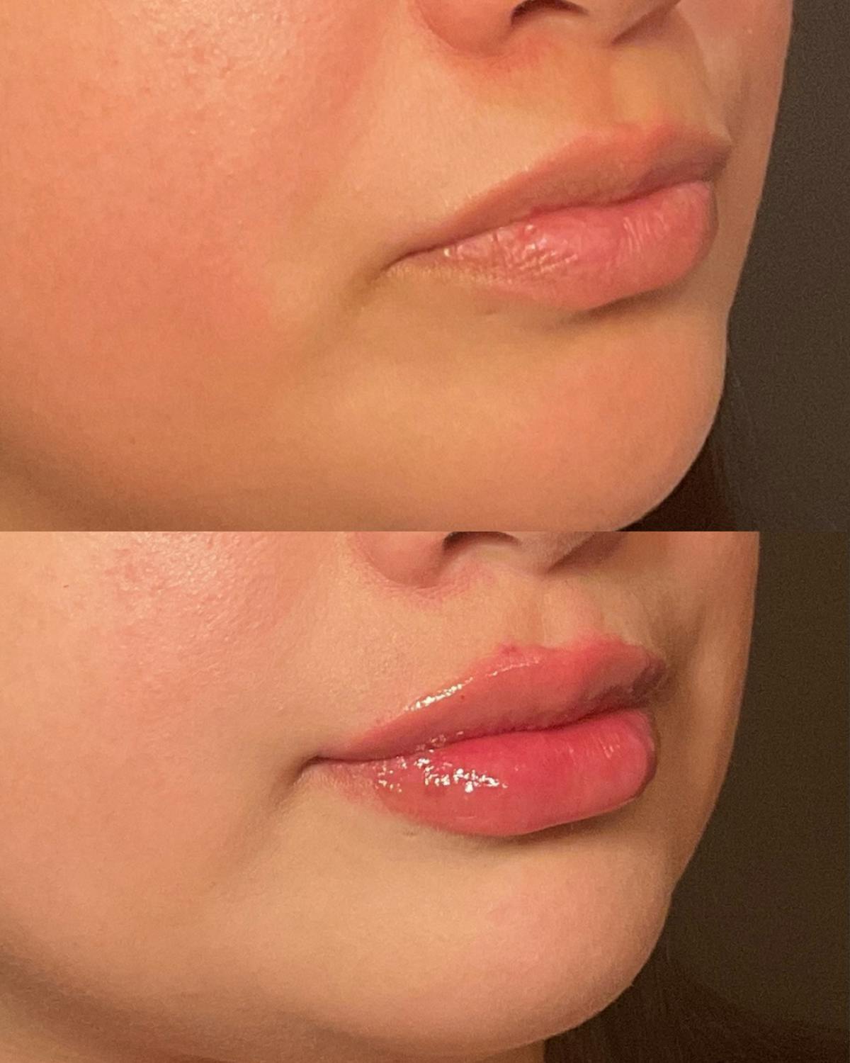 Lip Filler Before & After Gallery - Patient 343725 - Image 2