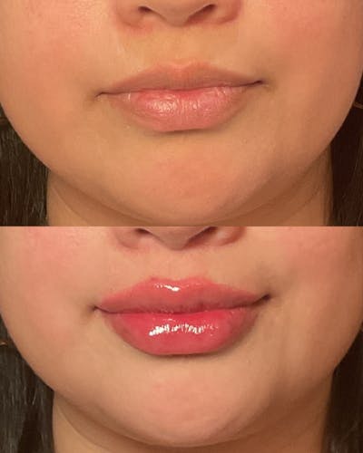 Lip Filler Before & After Gallery - Patient 343725 - Image 1