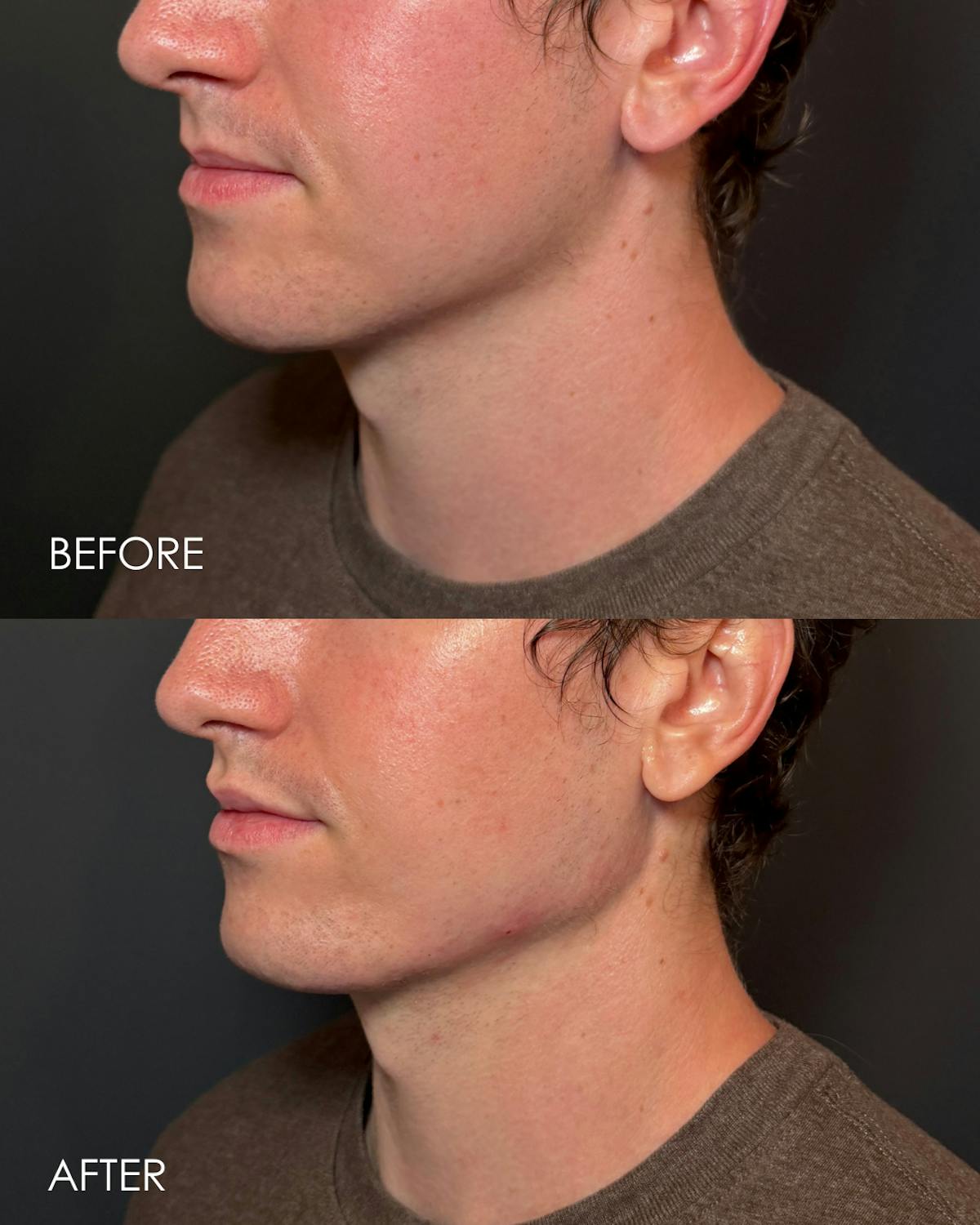 Radiesse Before & After Gallery - Patient 670742 - Image 2