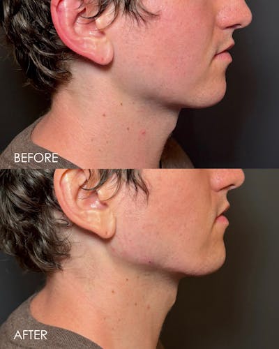 Radiesse Before & After Gallery - Patient 670742 - Image 1
