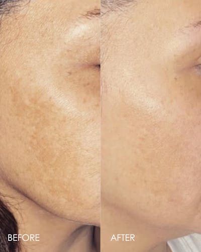 Aerolase Before & After Gallery - Patient 353898 - Image 1