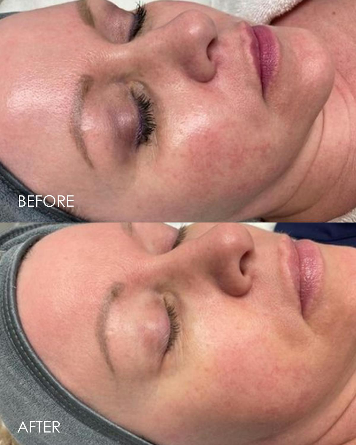 Aerolase Before & After Gallery - Patient 943971 - Image 1