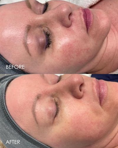 Aerolase Before & After Gallery - Patient 943971 - Image 1