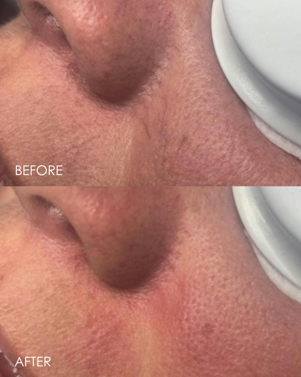 Aerolase Before & After Gallery - Patient 405041 - Image 1
