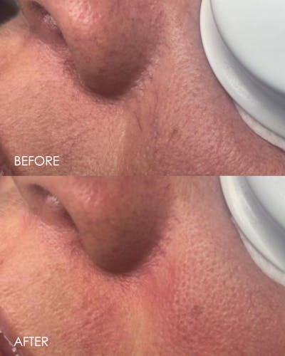 Aerolase Before & After Gallery - Patient 405041 - Image 1