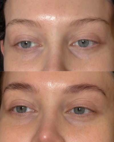 Brows Before & After Gallery - Patient 156824 - Image 1