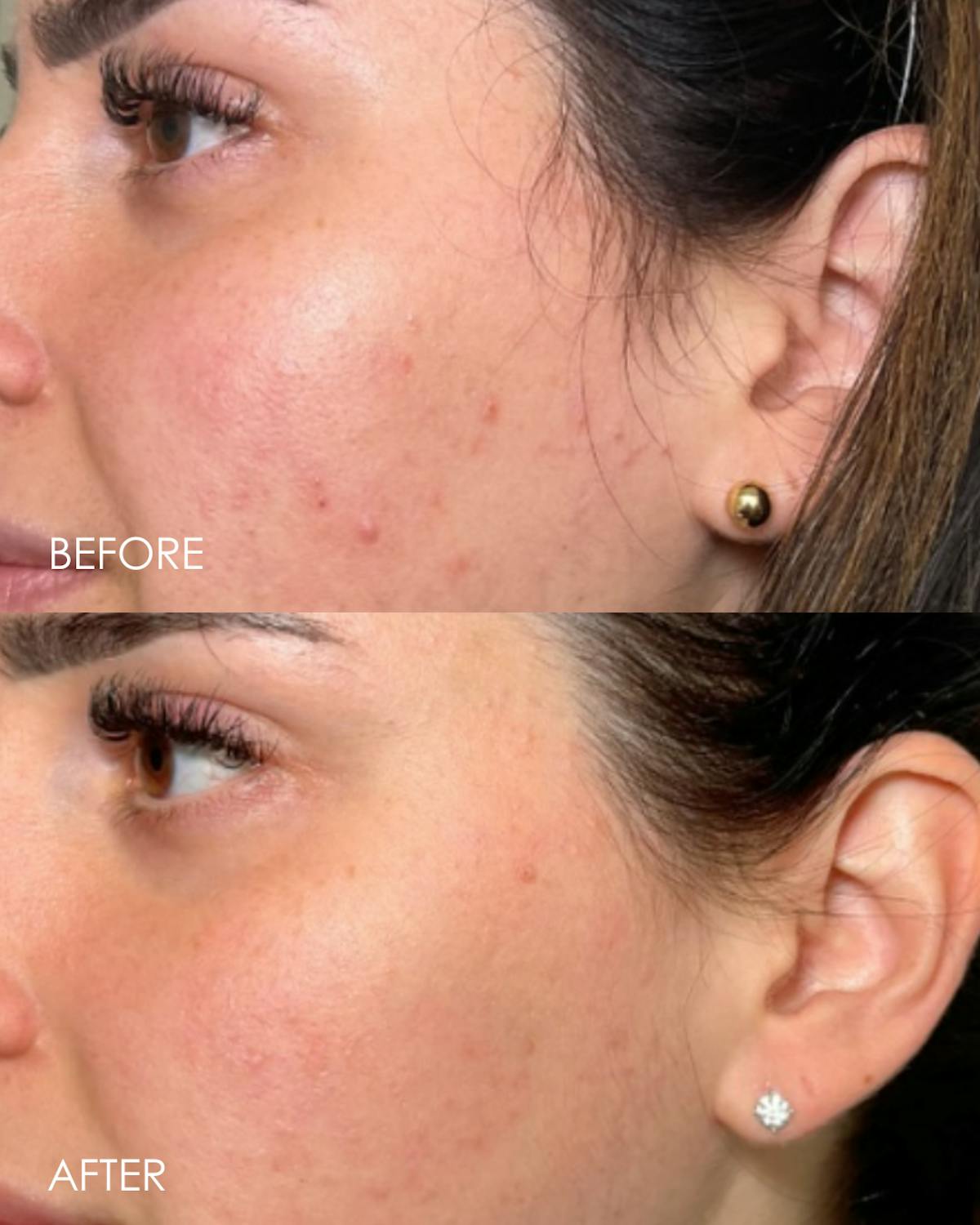 PRX DERM PERFEXION Before & After Gallery - Patient 279681 - Image 1