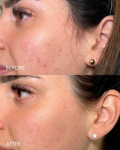 PRX DERM PERFEXION Before & After Gallery - Patient 279681 - Image 1