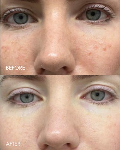 PRX DERM PERFEXION Before & After Gallery - Patient 490413 - Image 1
