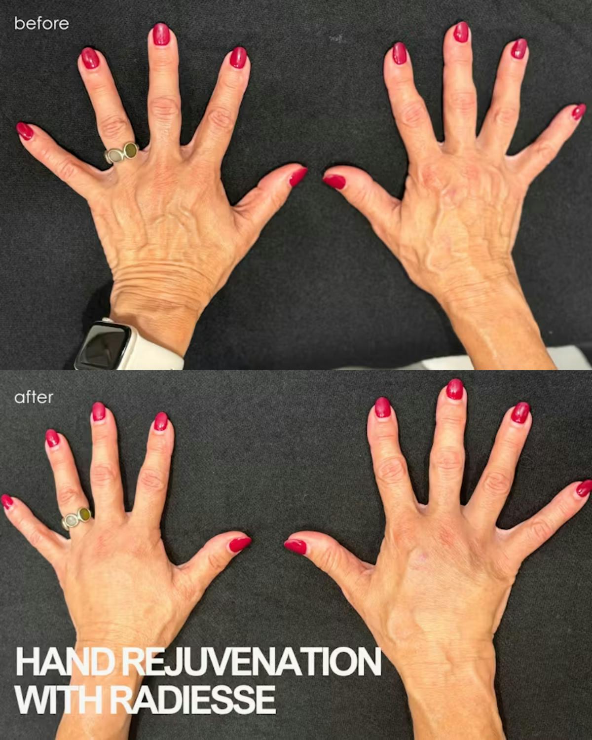 Radiesse Before & After Gallery - Patient 177739 - Image 1