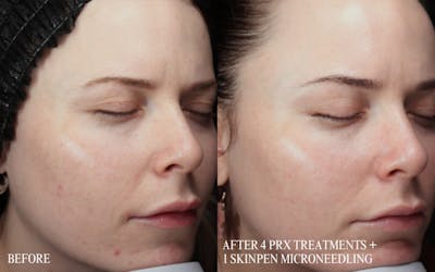 PRX DERM PERFEXION Before & After Gallery - Patient 660114 - Image 1