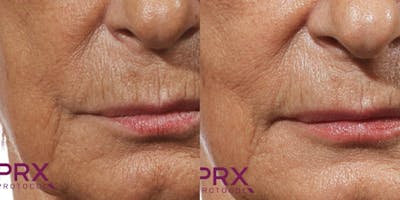 PRX DERM PERFEXION Before & After Gallery - Patient 234814 - Image 1