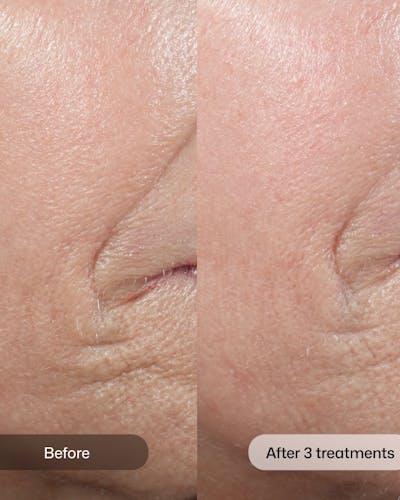 D.E.J BIOSTIM Before & After Gallery - Patient 341698 - Image 1