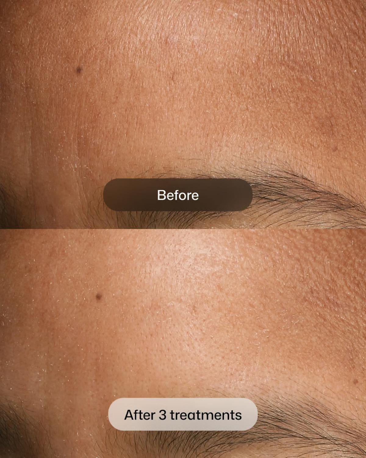 D.E.J BIOSTIM Before & After Gallery - Patient 366047 - Image 1