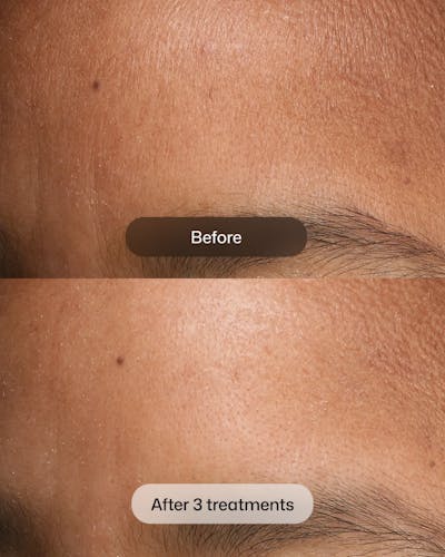 D.E.J BIOSTIM Before & After Gallery - Patient 366047 - Image 1