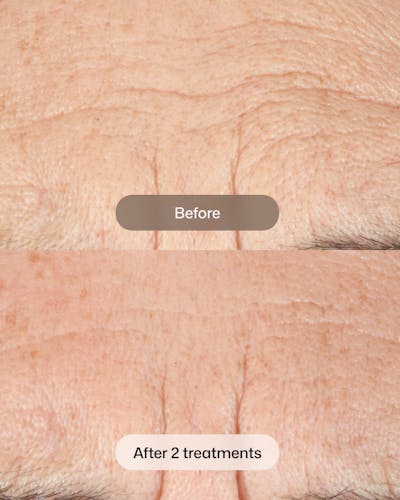 D.E.J BIOSTIM Before & After Gallery - Patient 120653 - Image 1
