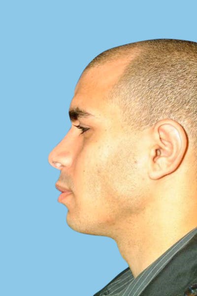 Rhinoplasty Before & After Gallery - Patient 190266 - Image 2