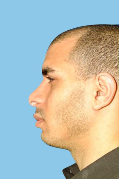 Rhinoplasty Before & After Gallery - Patient 190266 - Image 1