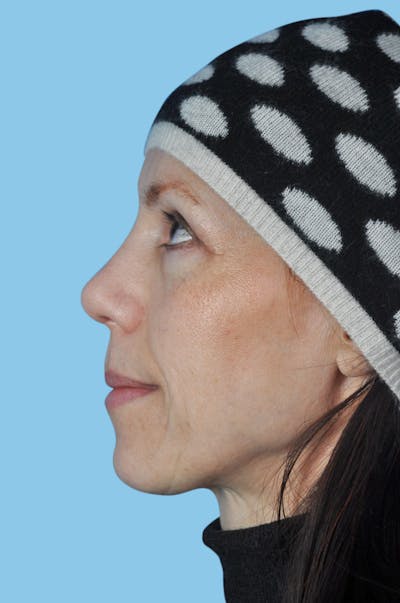 Rhinoplasty Before & After Gallery - Patient 412489 - Image 2