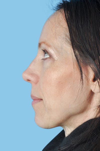 Rhinoplasty Before & After Gallery - Patient 412489 - Image 1