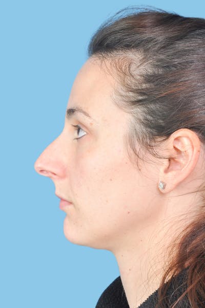 Rhinoplasty Before & After Gallery - Patient 593342 - Image 1
