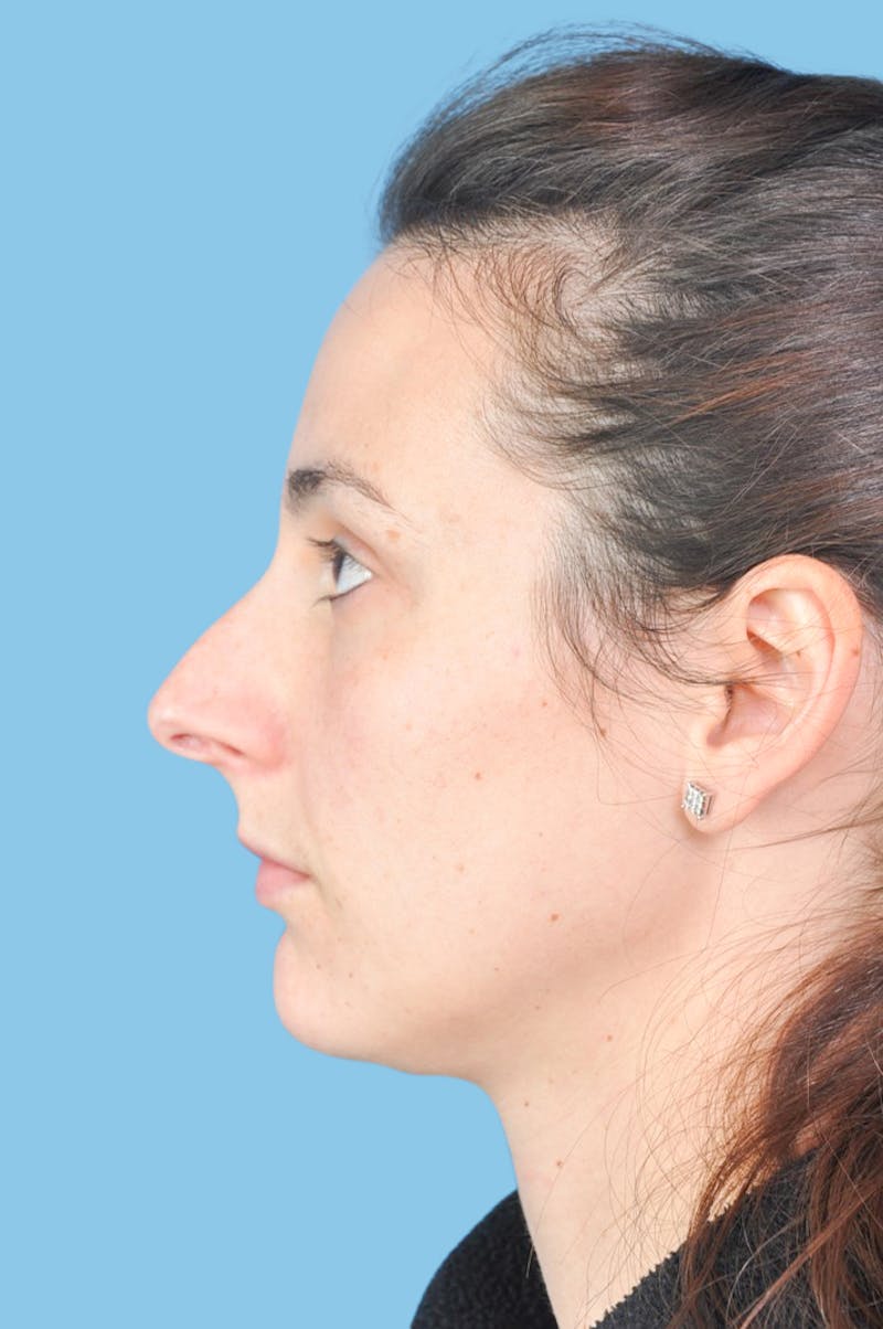 Rhinoplasty Before & After Gallery - Patient 593342 - Image 3