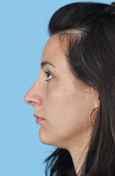 Rhinoplasty Before & After Gallery - Patient 593342 - Image 2