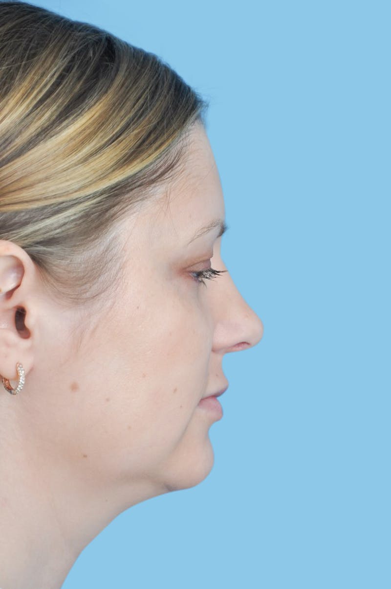 Revision Rhinoplasty Before & After Gallery - Patient 162036 - Image 4