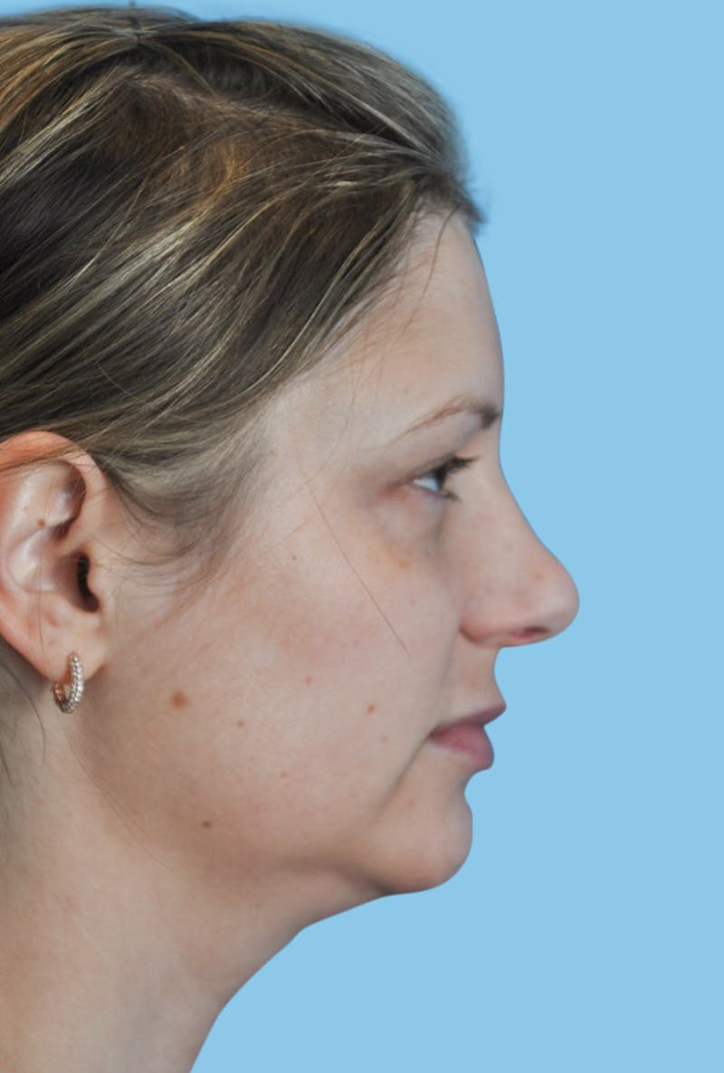 Revision Rhinoplasty Before & After Gallery - Patient 162036 - Image 3