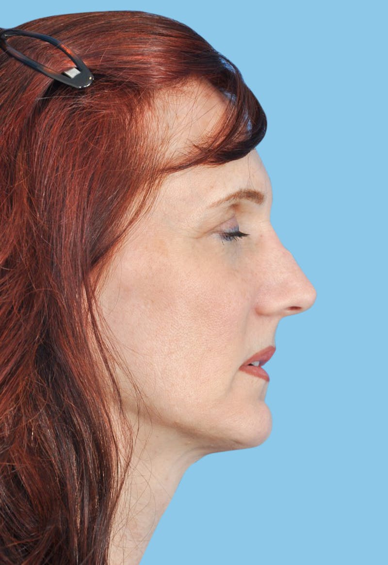 Revision Rhinoplasty Before & After Gallery - Patient 704582 - Image 3