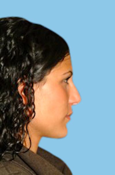 Rhinoplasty Before & After Gallery - Patient 112694 - Image 2