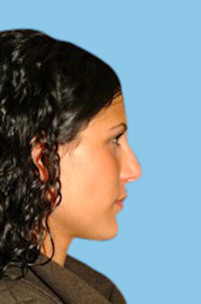 Rhinoplasty Before & After Gallery - Patient 112694 - Image 4