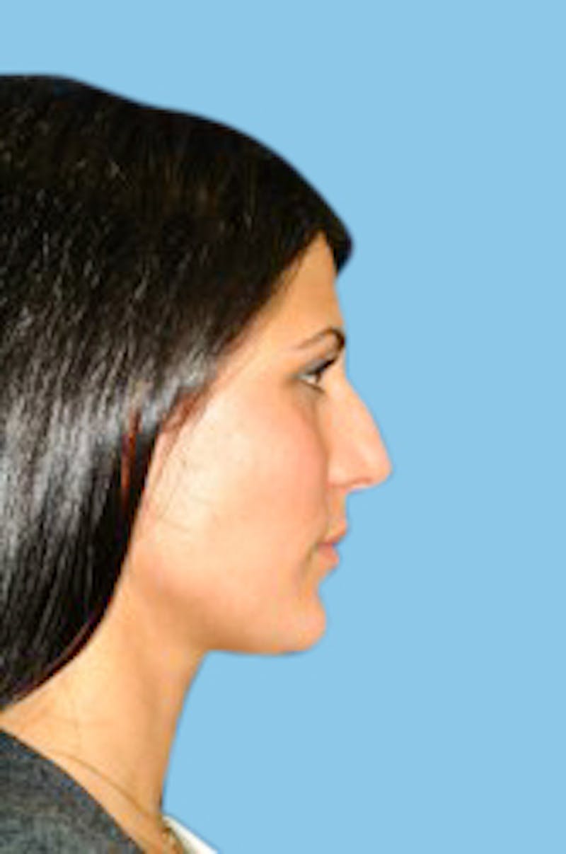 Rhinoplasty Before & After Gallery - Patient 112694 - Image 1