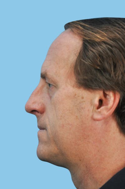 Rhinoplasty Before & After Gallery - Patient 254347 - Image 2