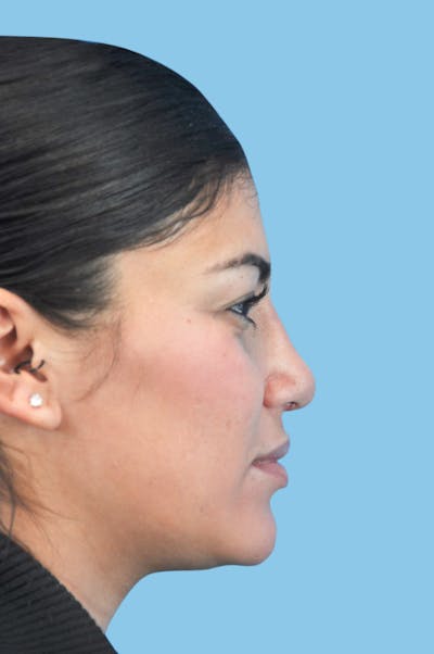 Rhinoplasty Before & After Gallery - Patient 197399 - Image 2