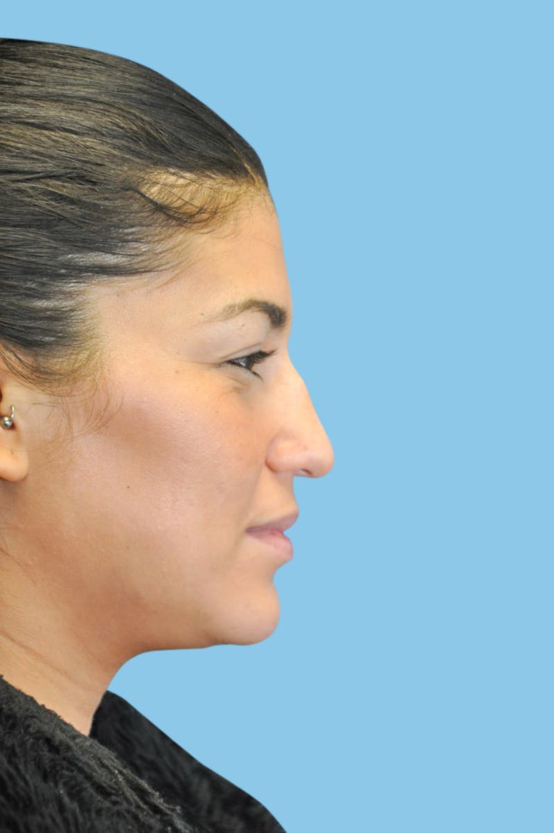 Rhinoplasty Before & After Gallery - Patient 197399 - Image 3