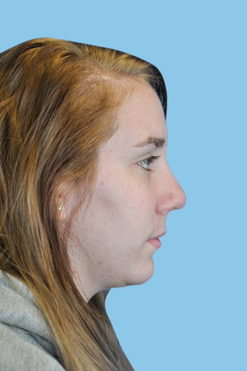 Rhinoplasty Before & After Gallery - Patient 676694 - Image 4