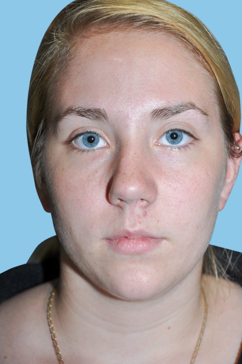 Rhinoplasty Before & After Gallery - Patient 676694 - Image 3