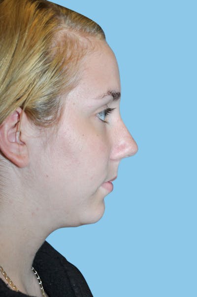 Rhinoplasty Before & After Gallery - Patient 676694 - Image 1